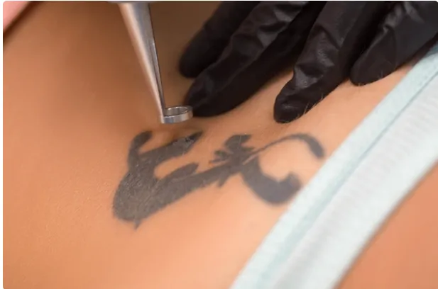 Eliminación de Tatuajes en Málaga y Benalmádena: Innovación y Precisión en el Cuidado de tu Piel